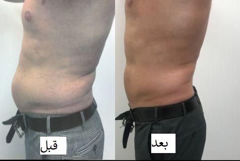 قبل و بعد از استفاده از دستگاه لاغری
