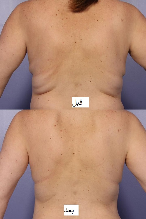 قبل و بعد از استفاده از دستگاه لاغری در بهترین کلینیک لاغری با دستگاه در تهران