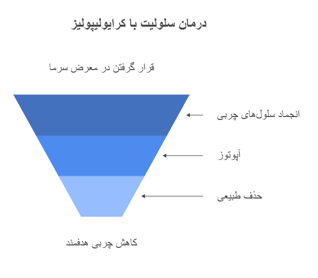 درمان سلولیت با کرایولیپولیز