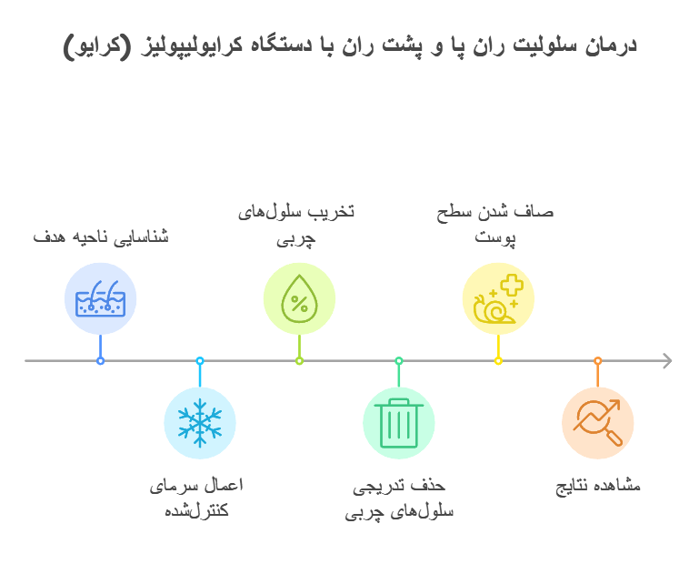 درمان سلولیت ران پا و پشت ران با دستگاه کرایولیپولیز (کرایو)