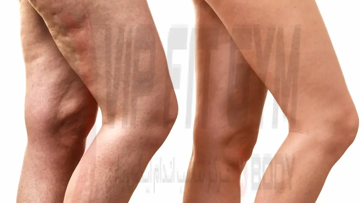 بررسی سلولیت در ساق پا - روش های درمان سلولیت در ساق پا