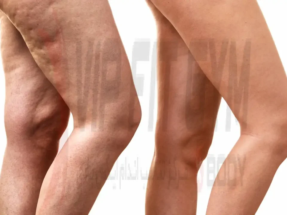 بررسی سلولیت در ساق پا - روش های درمان سلولیت در ساق پا