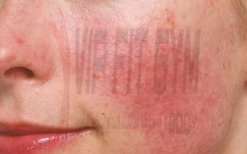 تفاوت های سلولیت و باد سرخ