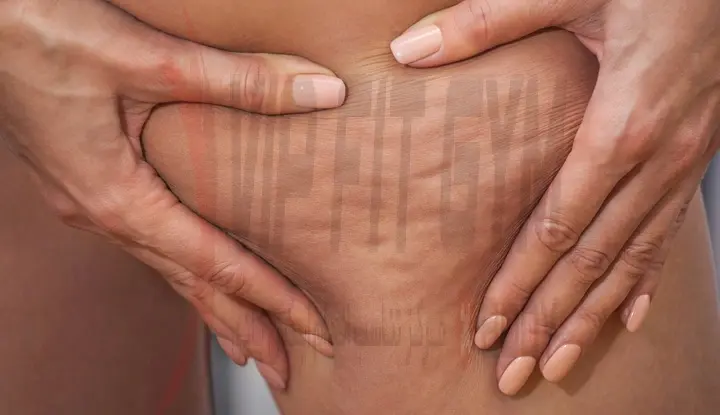 علائم سلولیت ساق پا چیست؟