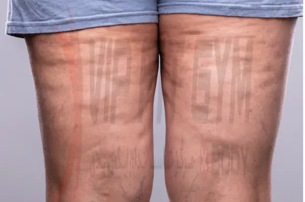 چرا سلولیت در ساق پا ظاهر می شود؟